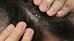 Lo shampoo non serve: dite addio alla forfora con una spezia presente in ogni casa